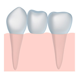 dental bridge for missing teeth with a dentist in Athens